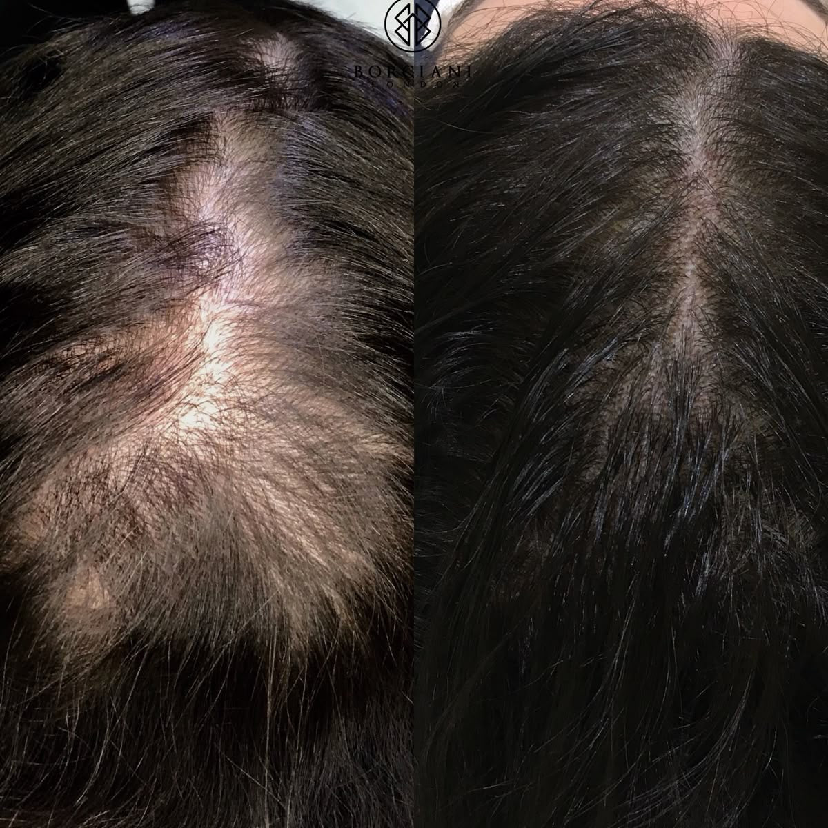 Maschera naturale per la crescita dei capelli (Olio 100% di Batana)